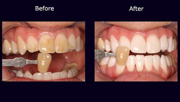 Teeth whitening Symonds Yat